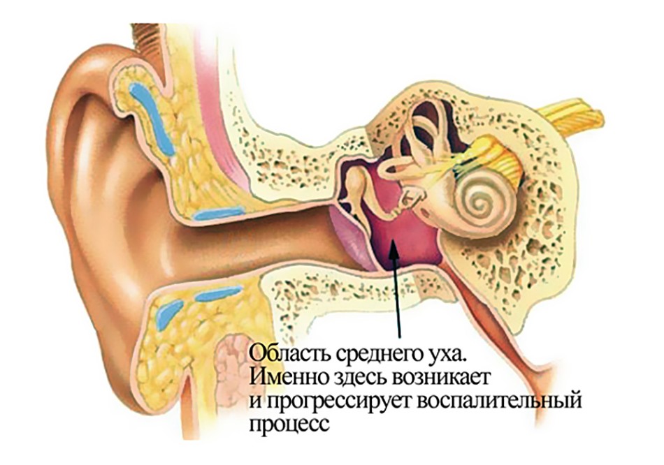 Воспаление среднего уха