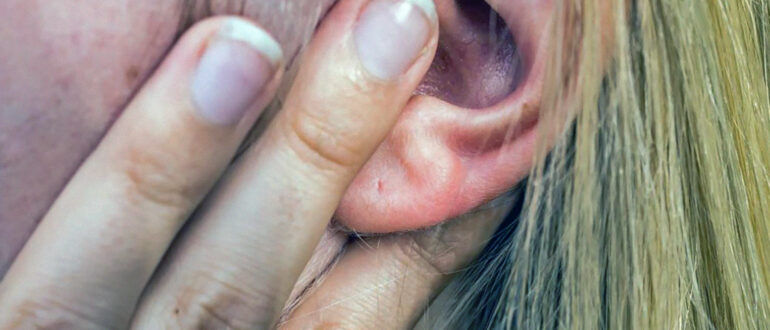 Атерома ушной раковины