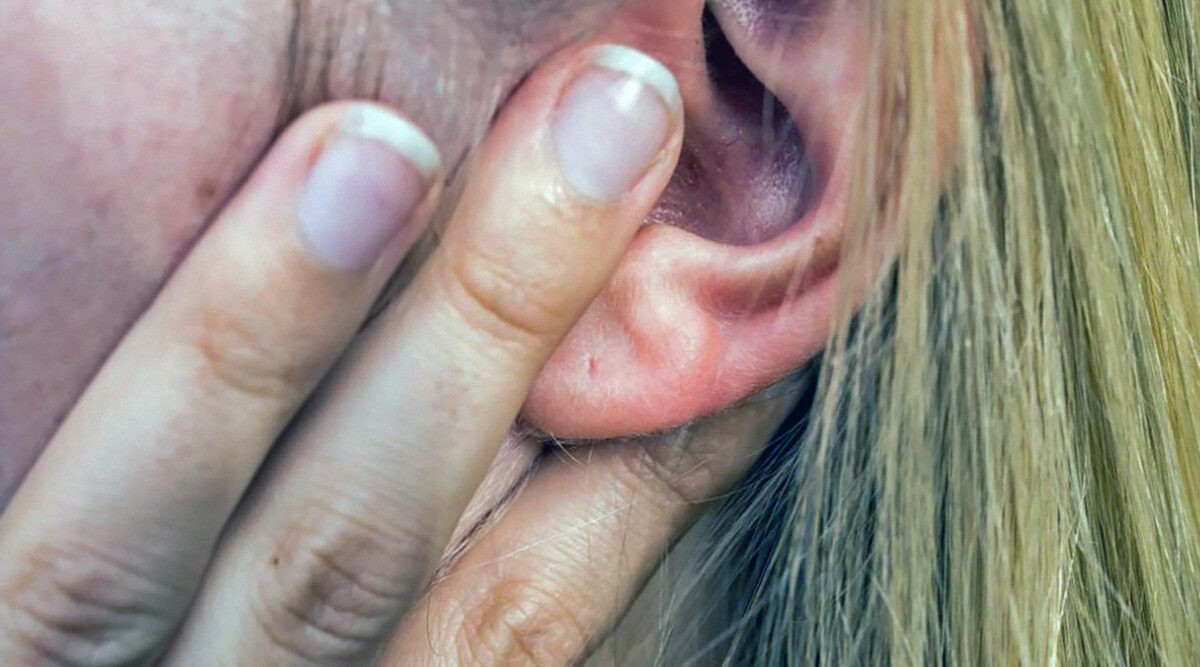 Атерома ушной раковины