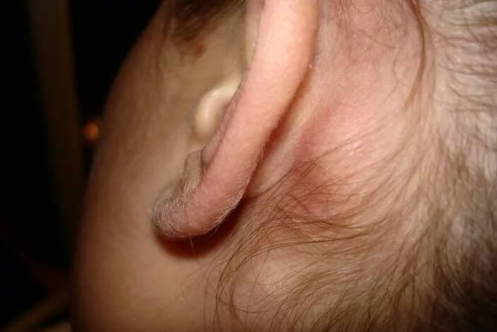 Болит ухо при надавливании на козелок лечение thumbnail