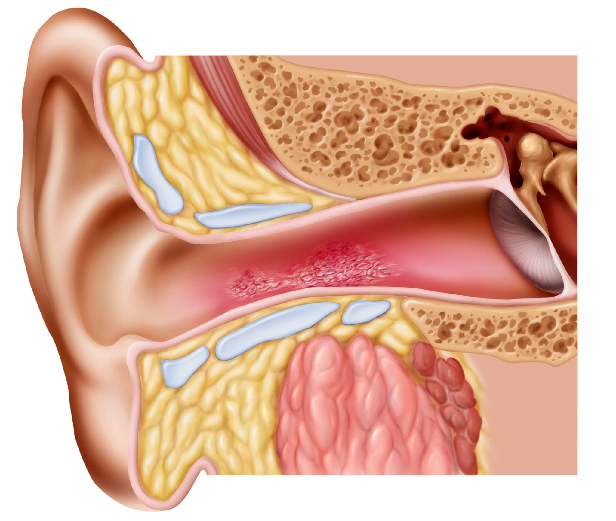 Причины воспаления среднего уха. Золотистый стафилококк отит.